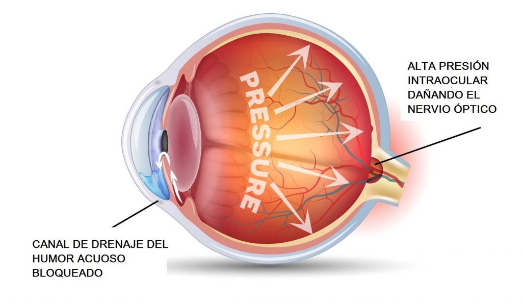 10 datos importantes para un diagnóstico oportuno de glaucoma