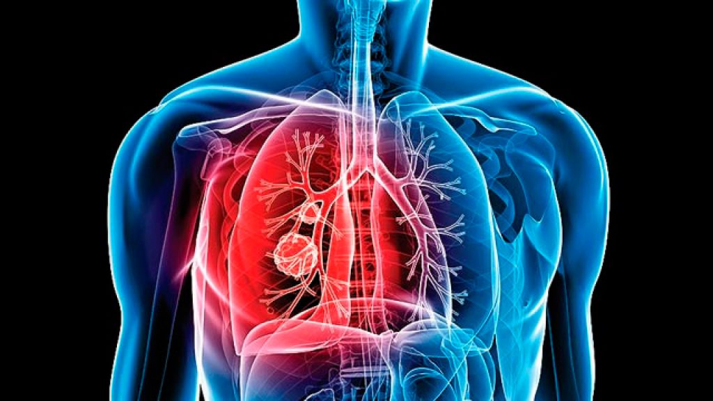 Tuberculosis, ¿Qué es y cómo se alivia uno de ella?